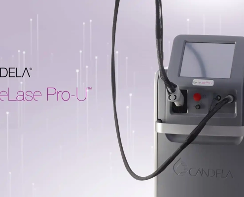 لیزر موهای زائد الکساندریت کندلا