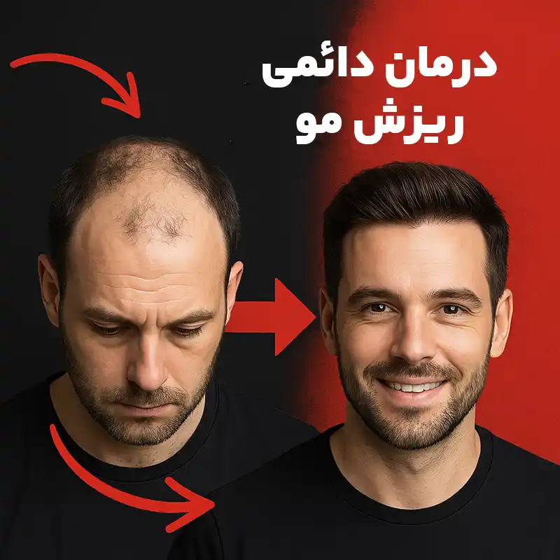 درمان دائمی ریزش مو درمان دائمی ریزش مو